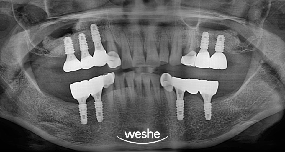 강서구 치과 어금니 임플란트 가용골 부족할 때 네비게이션 1차 2차 수술 로 해결하는 방법 관련 이미지 11