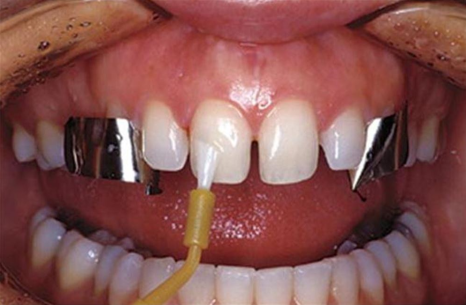 송정 치과 앞니 레진 변색 제거 후 전치부 치아 라미네이트 과정 관련 이미지 9