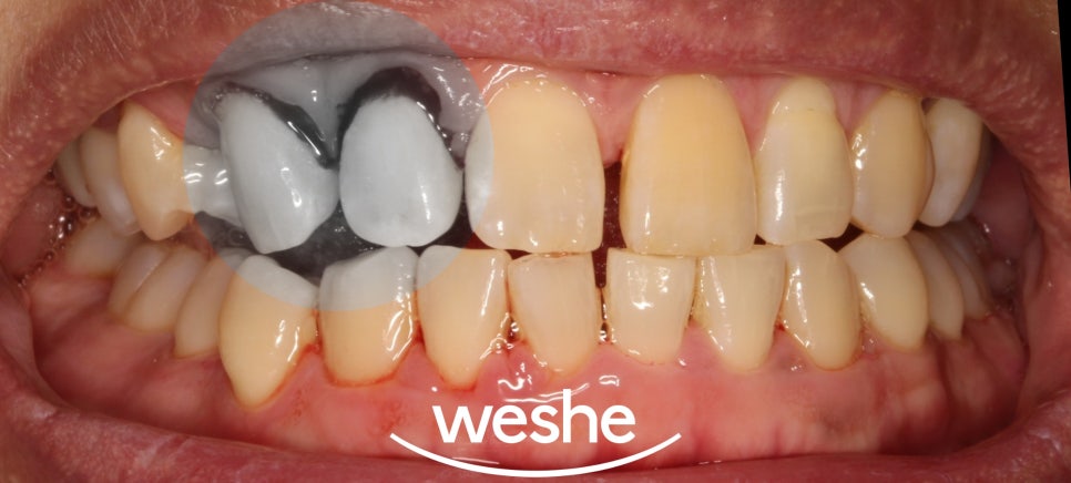 헛구역질(gagging reflex) 때문에 포기했던 구강진료, 해결할 수 있는 방법은? 마곡 수면치과 사랑니발치, 원데이 인레이, 치주치료 관련 이미지 4