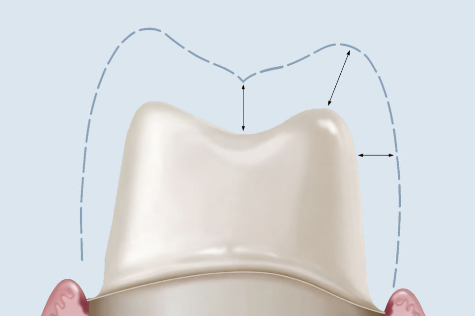 마곡 치과  앞니 깨짐, 크라운 없이 레진으로 치료가 가능할까? 진료 방법을 선택하는 기준과 과정 관련 이미지 3