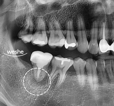마곡 치과 어금니 통증 발치를 해야 될까? 그 전에 알아야 될 치아 재식술 관련 이미지 2
