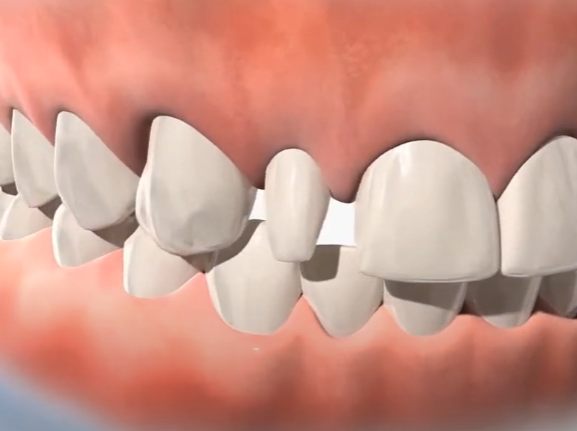 강서구 치과 앞니 라미네이트 제작을 위한 단계 진단 및 분석 절차 과정은? 관련 이미지 4