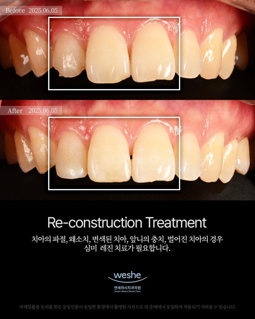 ✨ Re-construction Treatment &ndash; 레진 치료 전후 ✨ 관련 이미지 1