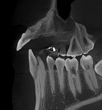 마곡동 치과 치주질환으로 인한 치아 벌어짐, 그리고 임플란트 치료 과정 관련 이미지 4