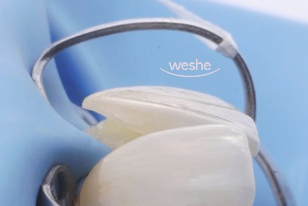 😁 웃을 때 치아 사이 가 벌어져 보인다면? 마곡동 치과 라미네이트 로 해결! 관련 이미지 10