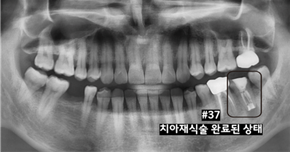신경치료한 어금니가 다시 욱신거리는데 왜 그럴까요? 관련 이미지 9