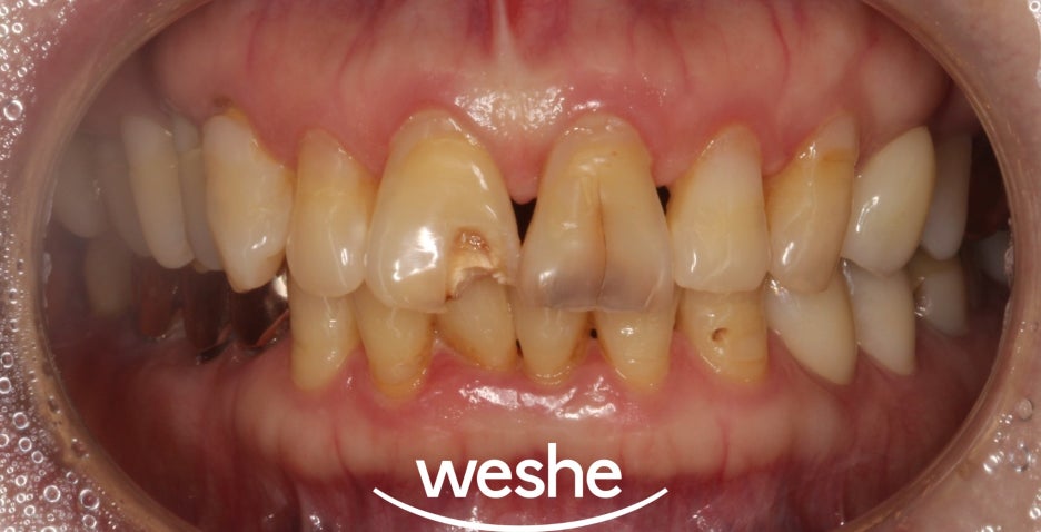 마곡 치과 앞니 파절, 충치 치아 레진으로 하루만에 해결할 수 있을까? 첫인상 하루만에 바꾸기 관련 이미지 5