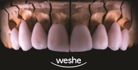 앞니 끝 깨짐 발산 치과 치아 라미네이트 치료 과정 관련 이미지 7