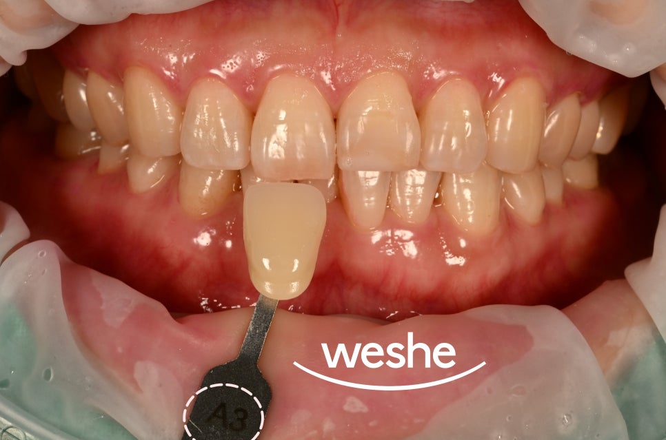 발산 치과 치아 미백 과정과 주의해야 되는 사항은? 담배, 커피 관련 이미지 2