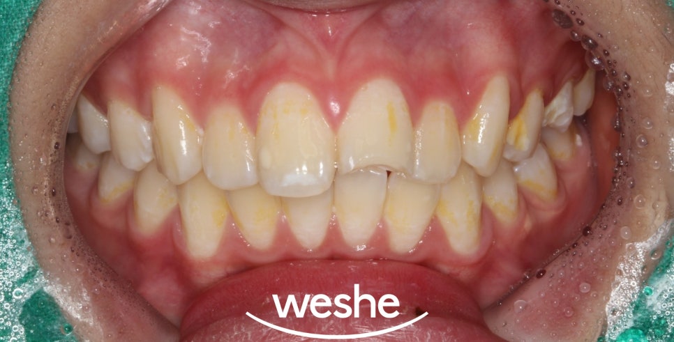 마곡동 치과 치아 파절 로 인한 레진 치료, 어떤 경우에 가능할까요? 관련 이미지 1