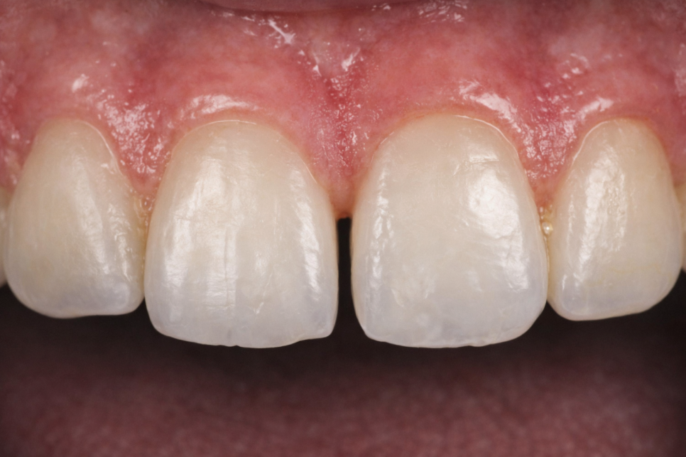 강서구 치과 앞니 사이 벌어진 공간 다이아스테마를 개선하는 레진 수복, 라미네이트 이야기 관련 이미지 5