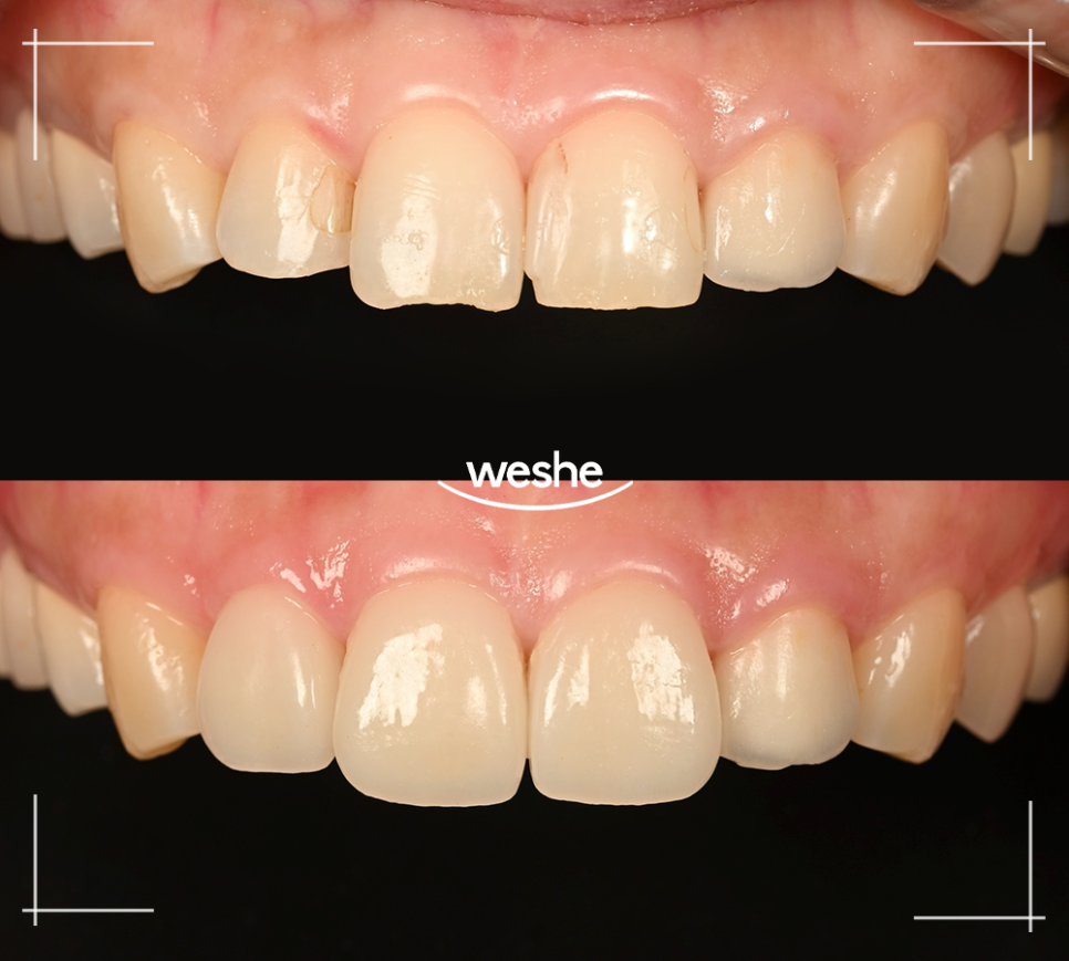 마곡동 치과 라미네이트 앞니 미세 파절, 변색 치료 사례 분석정리 관련 이미지 5