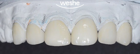 [강서구 치과] 치간이개, 앞니가 벌어졌다?! 치아 벌어짐, 초기 충치/ 라미네이트 치료 과정 관련 이미지 3