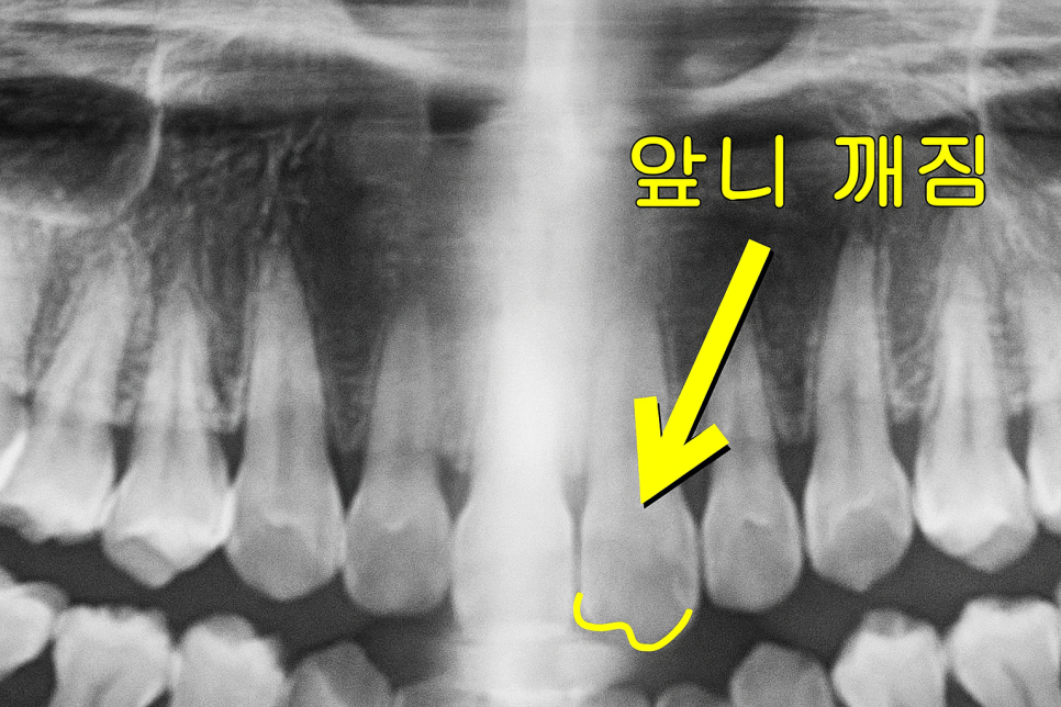 마곡 치과 에서 알려드리는 앞니 끝 깨짐, 치아 파절 레진 치료 방법 관련 이미지 1
