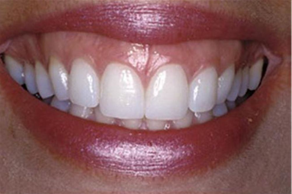 송정 치과 앞니 레진 변색 제거 후 전치부 치아 라미네이트 과정 관련 이미지 12