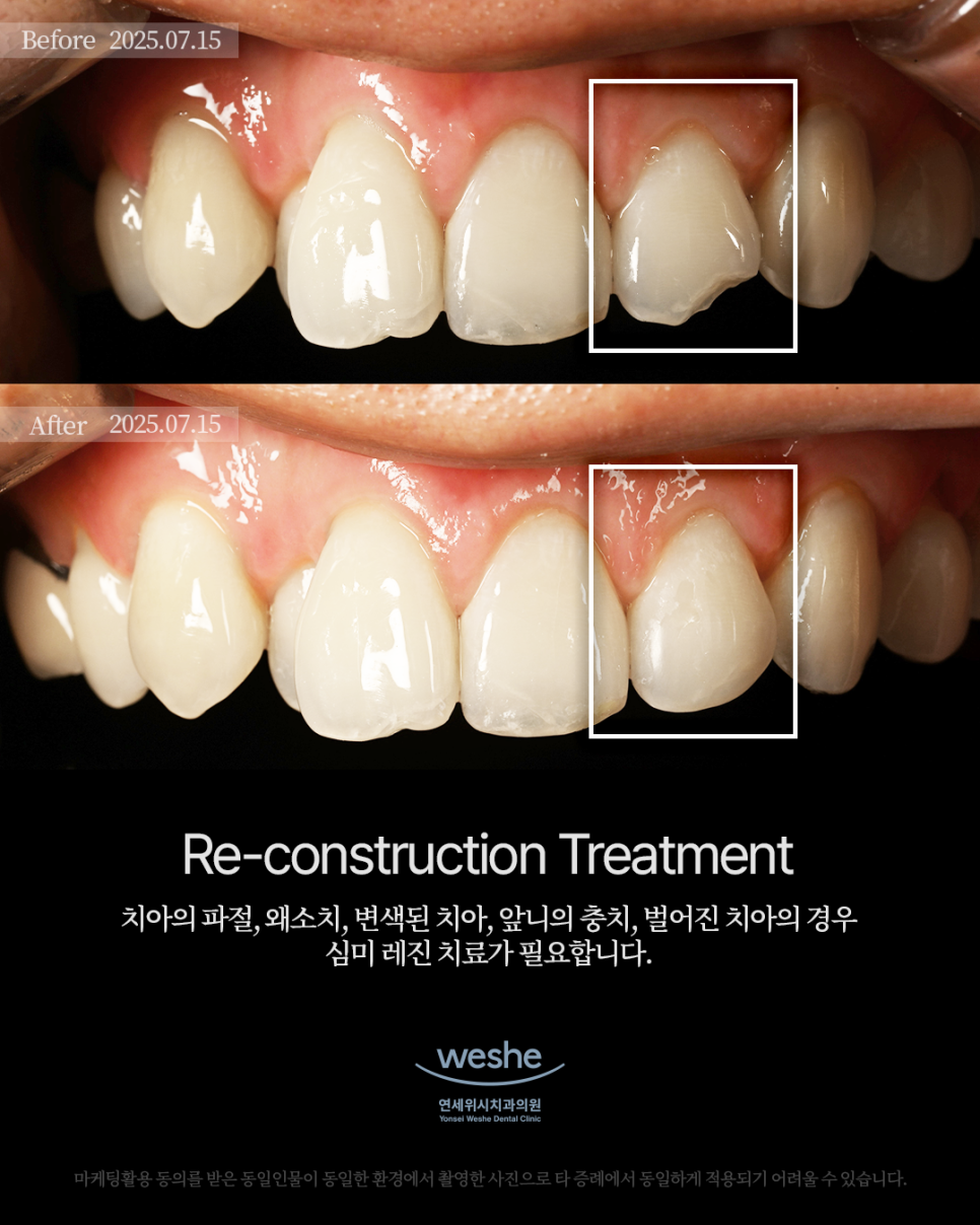 ✨ Re-construction Treatment &ndash; 레진 치료 전후 ✨ 관련 이미지 1