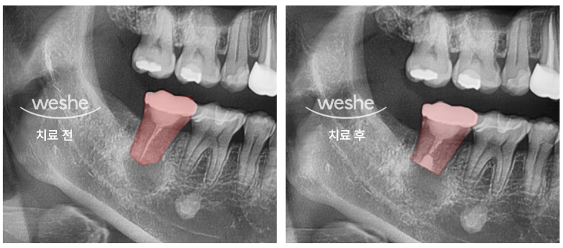 마곡역치과 치아, 진짜 뽑아야 되는 걸까요? 치아재식술이란? 관련 이미지 7
