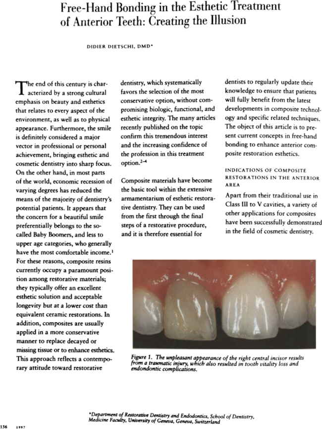 마곡 치과  앞니 깨짐, 크라운 없이 레진으로 치료가 가능할까? 진료 방법을 선택하는 기준과 과정 관련 이미지 6