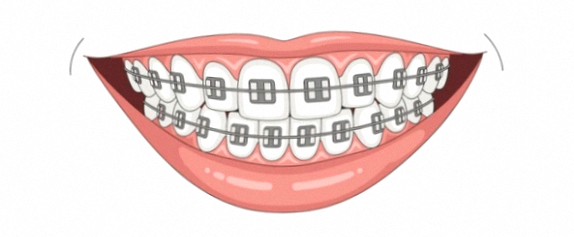 Gangseo-gu Dental Clinic: Wondering Whether to Choose Whitening, Orthodontics, or Veneers? image 5