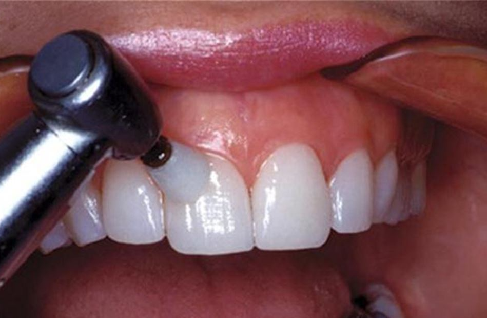 송정 치과 앞니 레진 변색 제거 후 전치부 치아 라미네이트 과정 관련 이미지 11