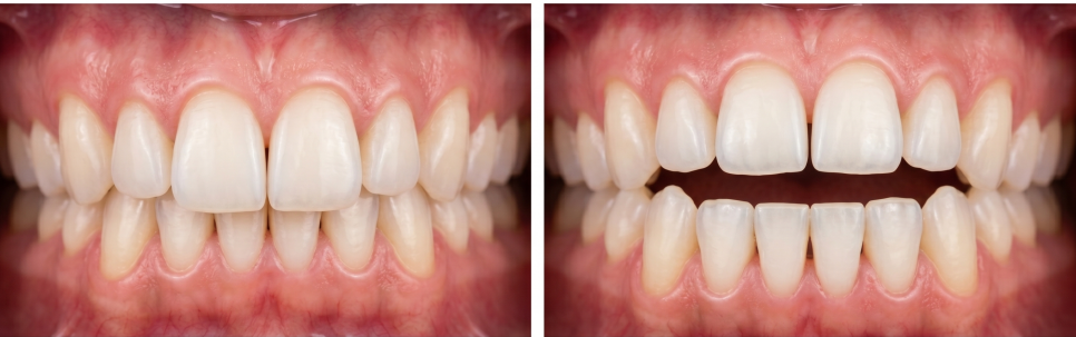 Clear Aligners vs. Bracket Orthodontics: How to Choose Based on Your Case, Explained by a Balsan-dong Dentist image 4