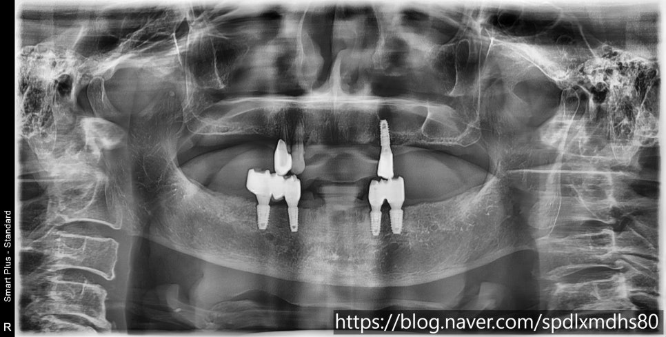 The Warmth a Patient Shared After Receiving Implant-Supported Dentures image 2