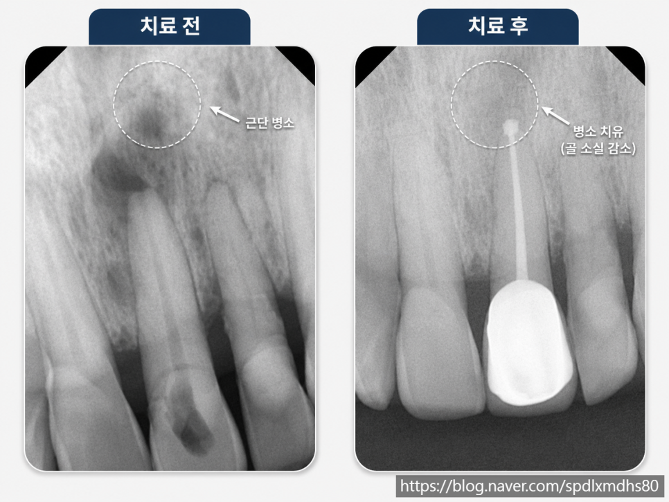 Root Canal Treatment at Magok Station: The Pain Is Gone—Do I Still Need to Continue Treatment? image 6
