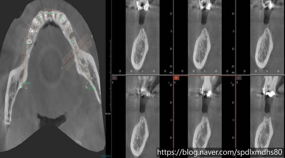 Gangseo-gu Dental Clinic: Can Implant Surgery Be Performed More Accurately and Comfortably? image 3