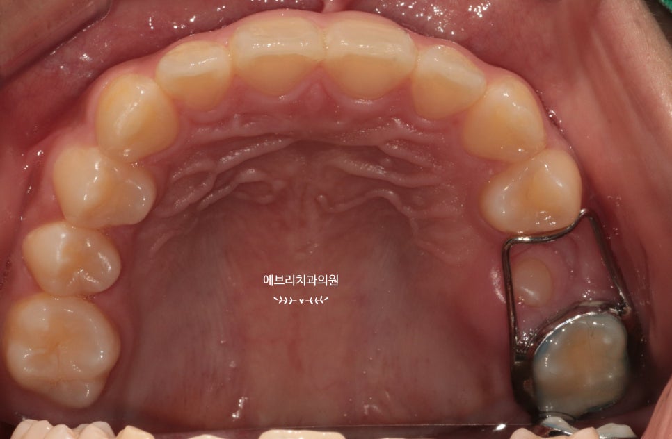 내발산동 치과,아이 치아가 안나와요. 그냥두면될까요? 관련 이미지 3