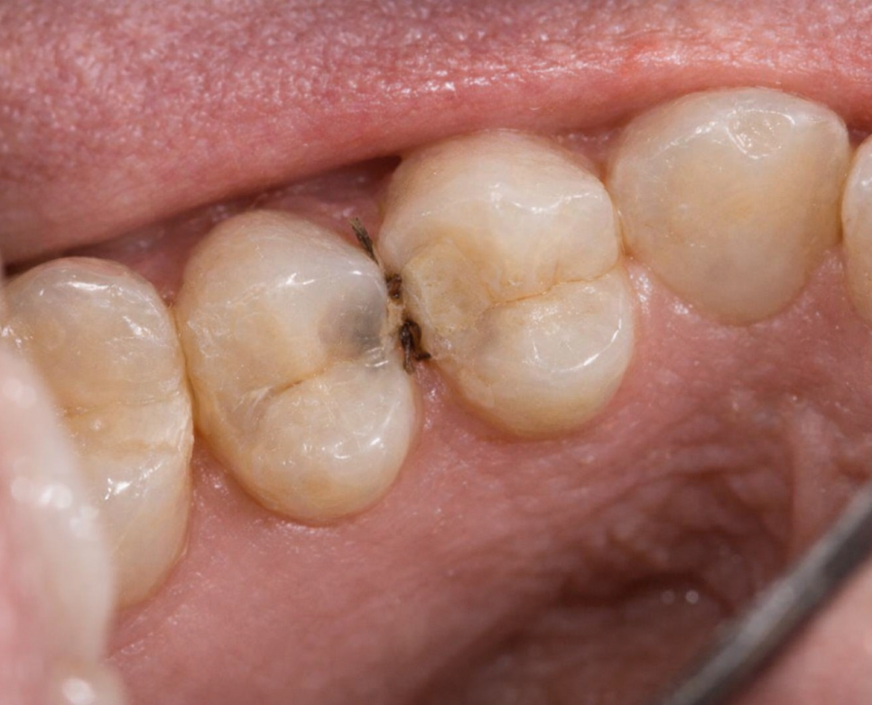 강서 치과 에서 알아보는 치아 사이 인접면 충치의 위험성 (ft. 정기검진의 중요성) 관련 이미지 3