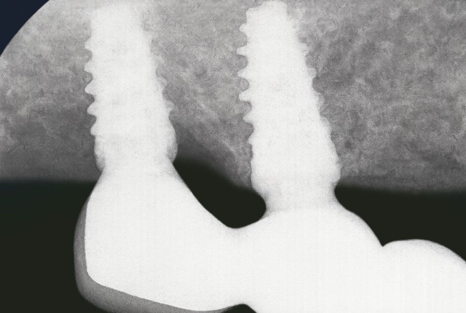 발산동 치과 리쥬란이라 불리는 PDRN 잇몸 치료 & 골이식 관련 이미지 4