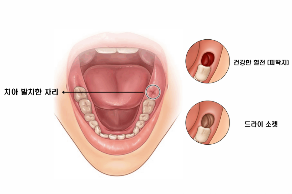 마곡동 치과 사랑니 발치 후 2~3일째 통증과 냄새가 느껴진다면? 드라이소켓 주의 관련 이미지 2