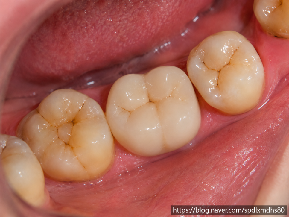 Root Canal Treatment at Magok Station: The Pain Is Gone—Do I Still Need to Continue Treatment? image 7
