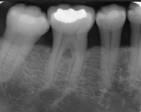 Causes of Tooth Loss Explained Through the Structure of Periodontal Tissues at Ujangsan Station Dental Clinic image 5