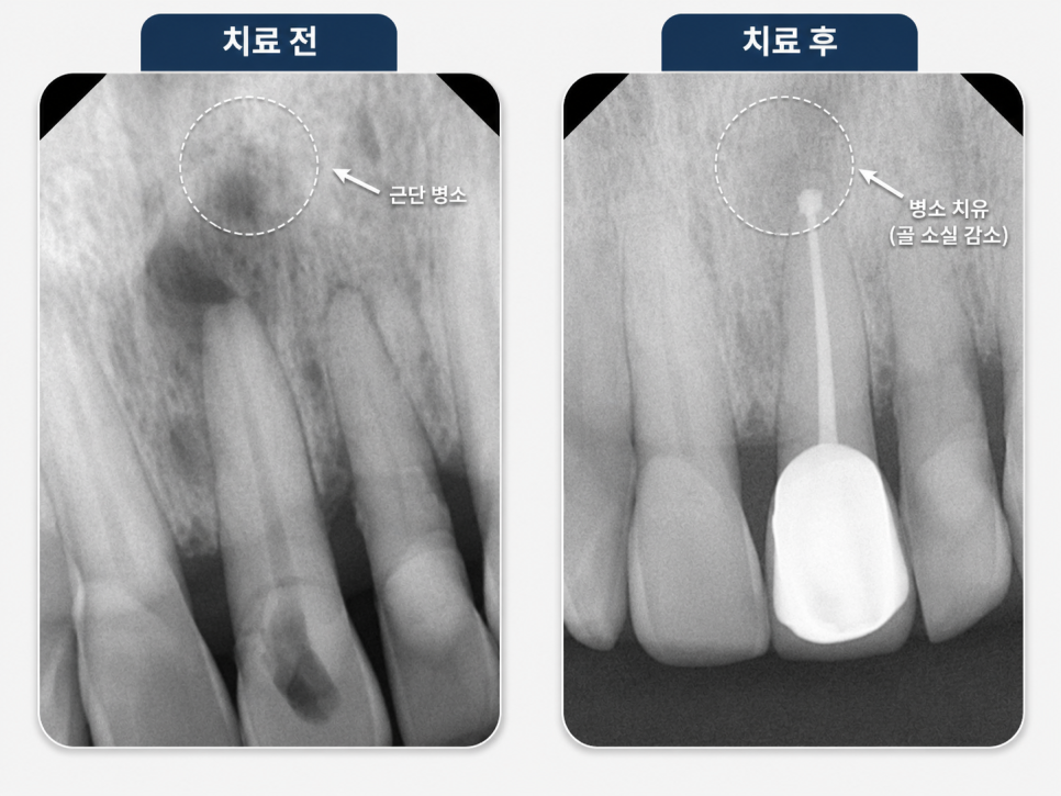 마곡치과, 신경치료가 두려운 분들을 위한 세심한 진료 관련 이미지 4