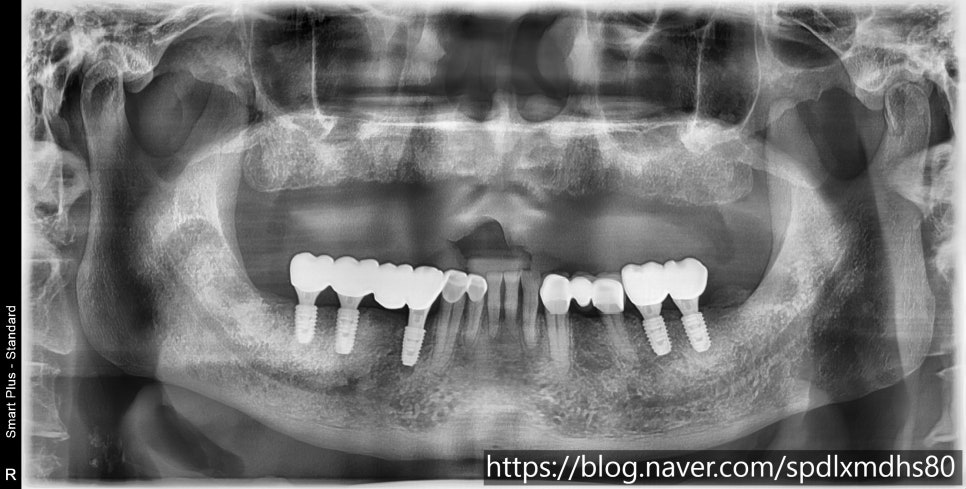 The Warmth a Patient Shared After Receiving Implant-Supported Dentures image 3