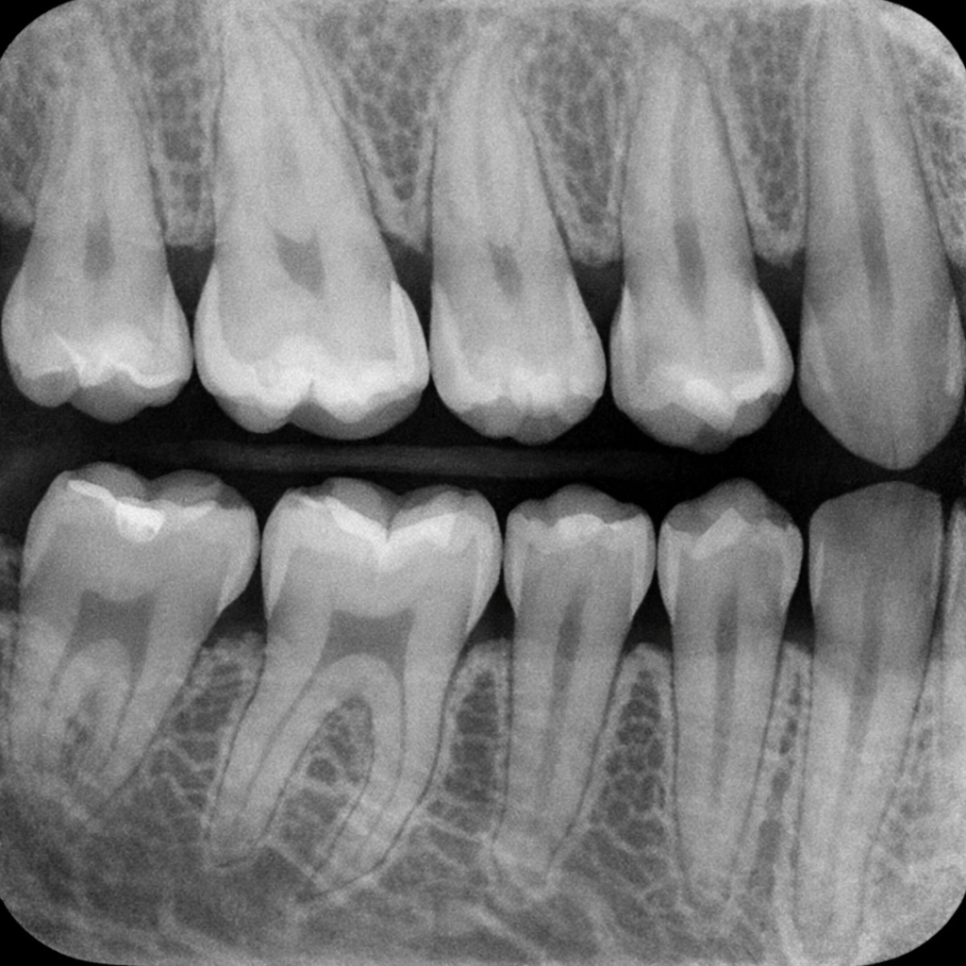 Understanding the Risk of Interproximal Cavities Between Teeth at a Dental Clinic in Gangseo (ft. The Importance of Regular Checkups) image 5