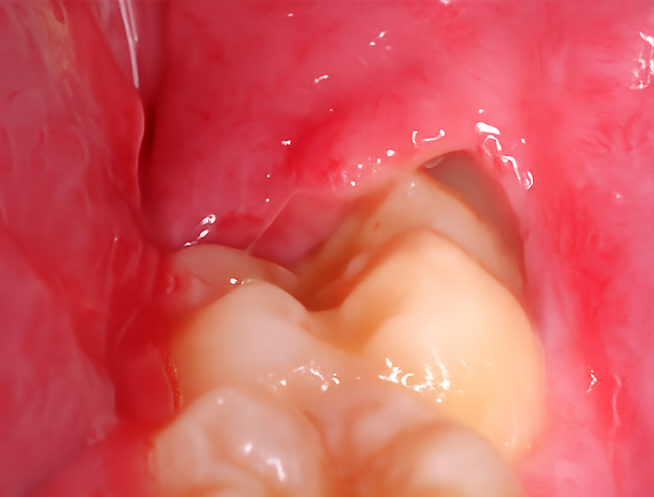 Maguok-dong Dental Clinic: If your gum keeps swelling around your wisdom tooth, let’s look at the causes of pericoronitis and how to manage it! image 1