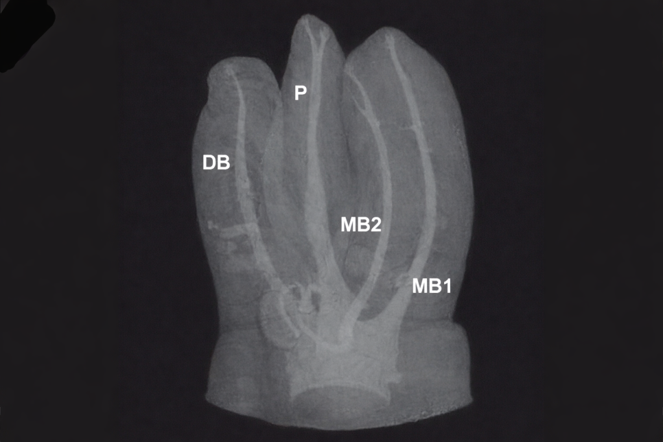마곡동 치과 신경치료, 뿌리 모양이 이상하다면? MB2/Radix Entomolaris 관련 이미지 2