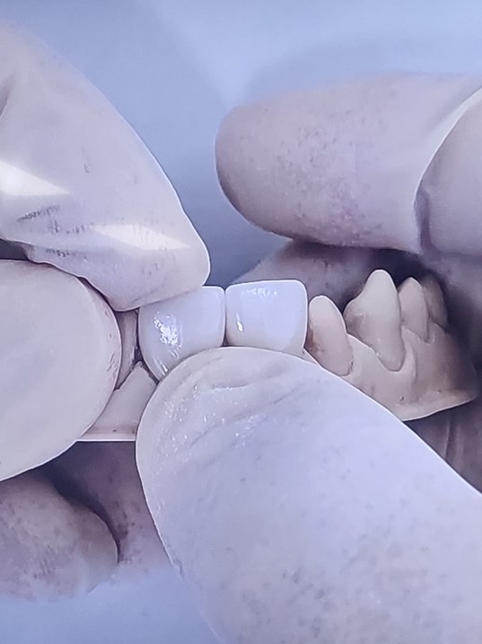 Naebalsan-dong Dental Laminates: Less Tooth Reduction, a More Beautiful Smile image 4
