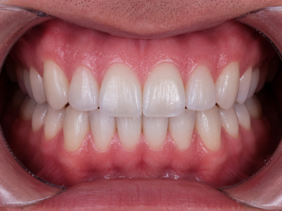Naebalsan-dong Dental Laminates: Less Tooth Reduction, a More Beautiful Smile image 2