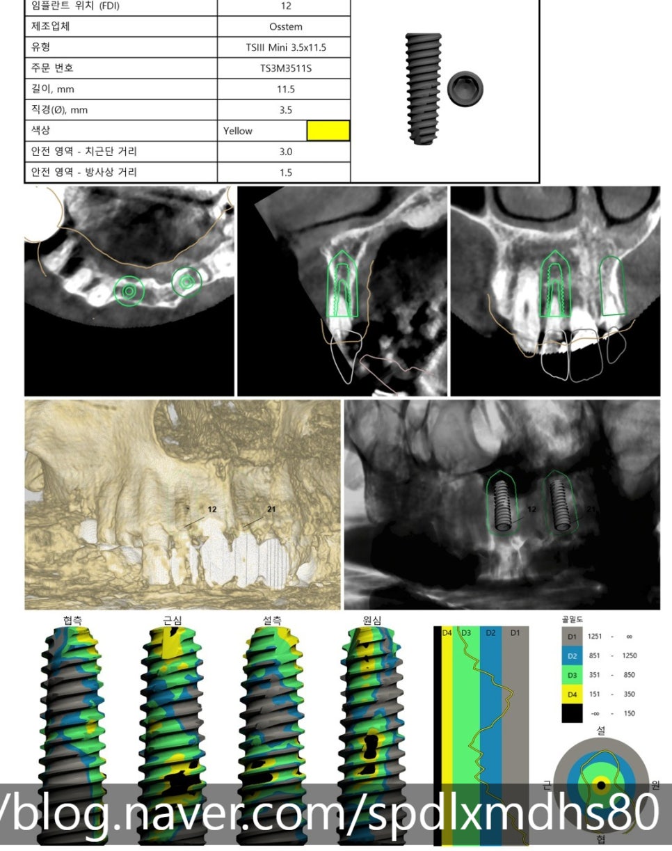 Gangseo-gu Dental Clinic: Can Implant Surgery Be Performed More Accurately and Comfortably? image 6