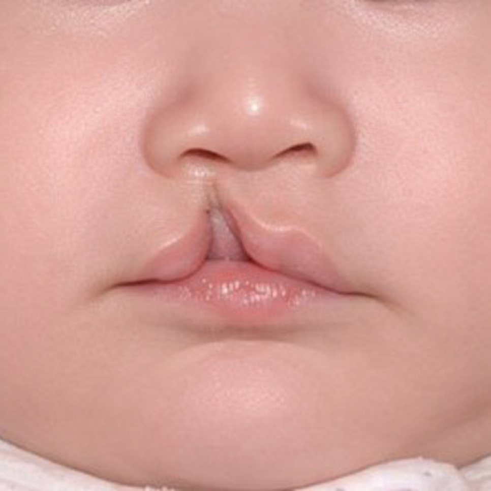 아이 입술&middot;입천장이 벌어졌다면? 마곡동 치과 의 구순구개열 구강 정보 관련 이미지 1