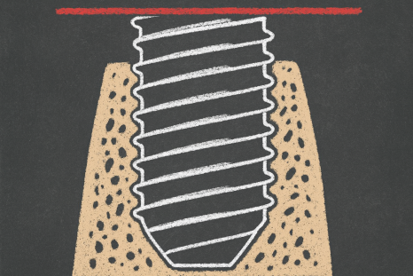 발치 후 임플란트 식립 시기 마곡동 치과 전문의 알려드립니다. 관련 이미지 3