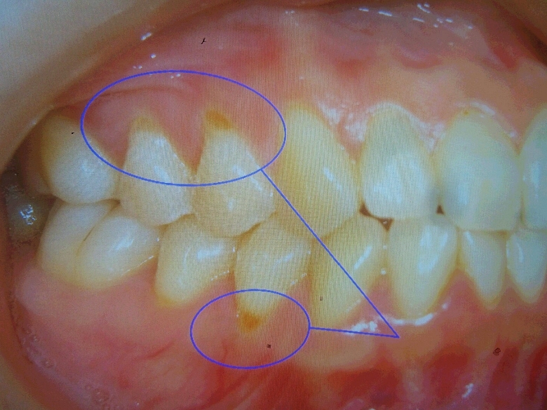 갑자기 이가 시려요. 에브리 치과 의원에서 알려드리는 여름철치아관리법 관련 이미지 5