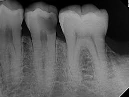The Difference Between Resin and Ceramic You Must Know Before Cavities Treatment at Balsan-dong Dental Clinic image 6