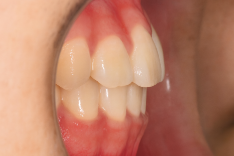 앞니 살짝 틀어짐, 발산동 치과 부분 교정 하고 싶은 분?! 관련 이미지 6