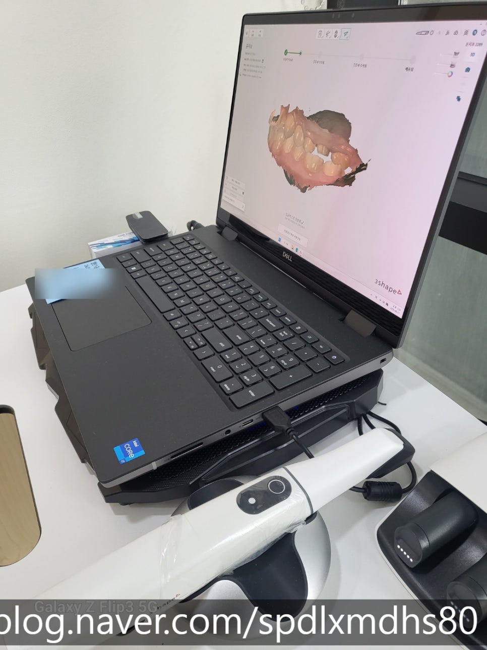 Gangseo-gu Dental Clinic: Can Implant Surgery Be Performed More Accurately and Comfortably? image 5
