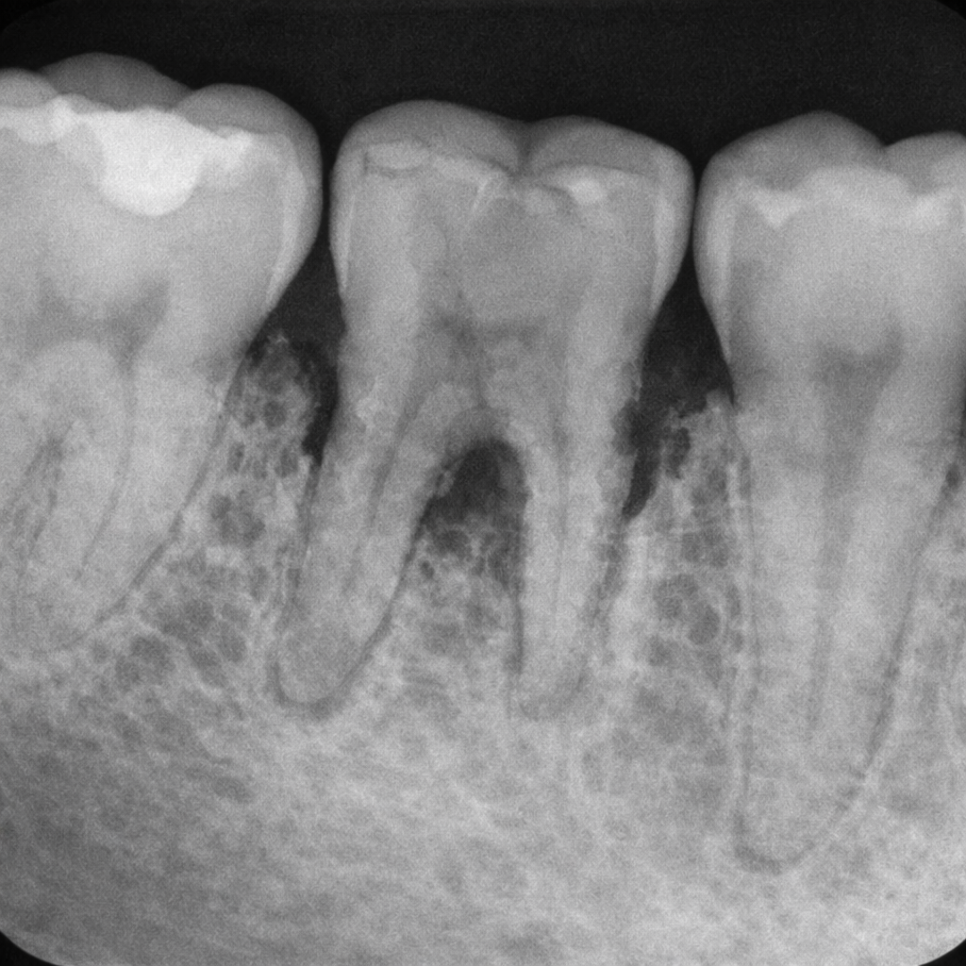 우장산 치과 잇몸 출혈, 치은염일까 치주염일까? 단계별 차이와 관리법 관련 이미지 2