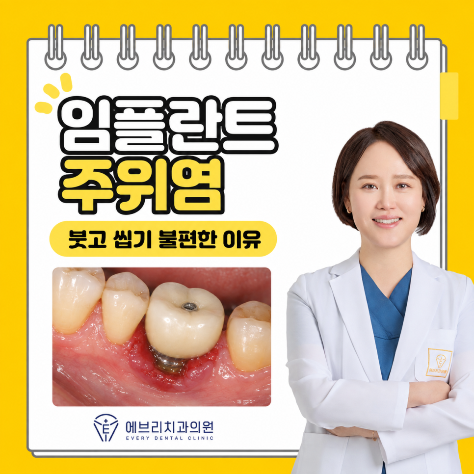 강서구 치과, 임플란트한 치아가 불편한 이유 관련 이미지 7
